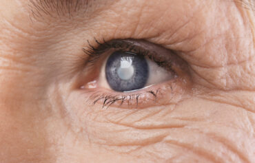 Cataracta