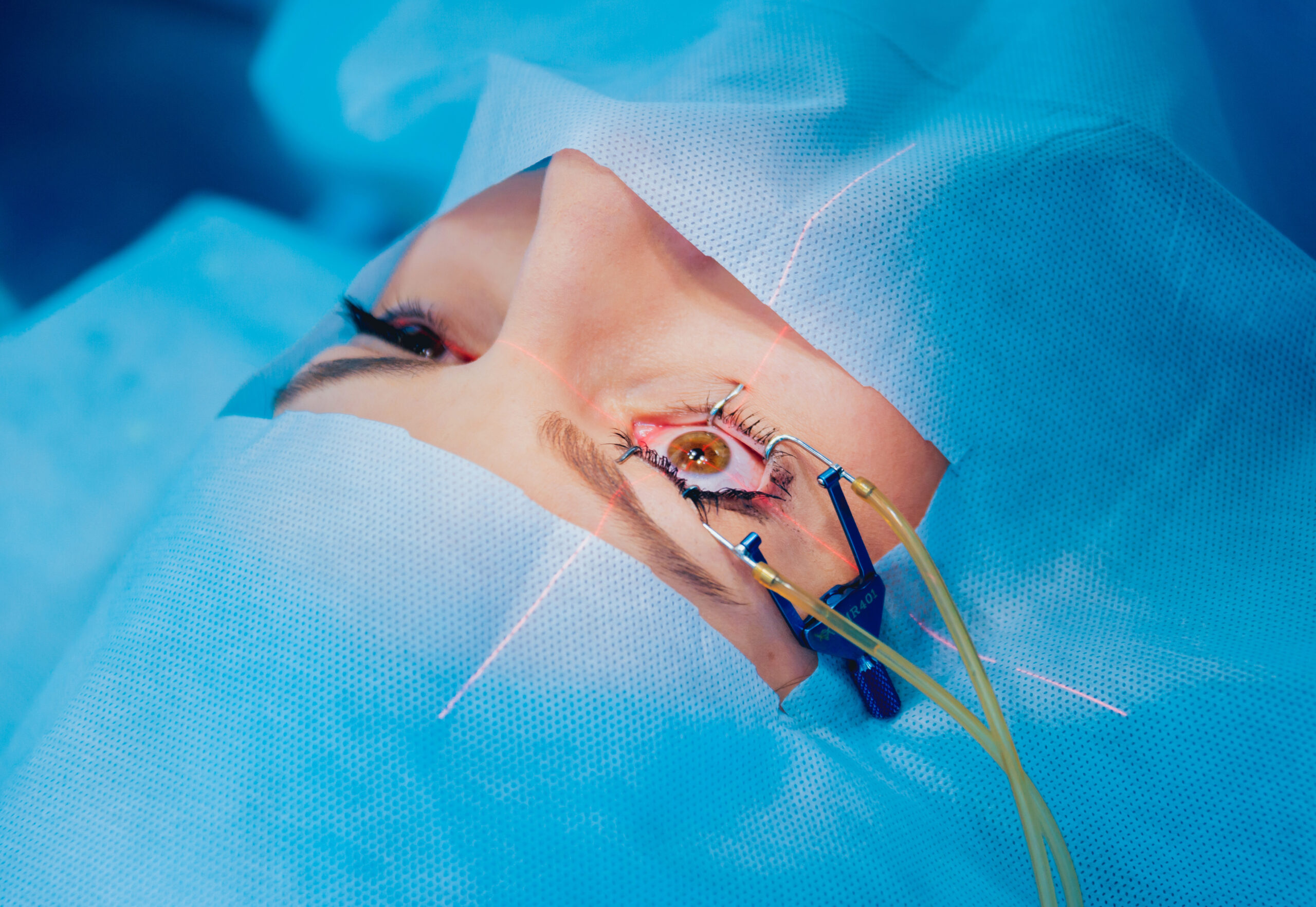 Laser,Vision,Correction.,A,Patient,And,Team,Of,Surgeons,In