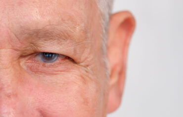 Glaucoma