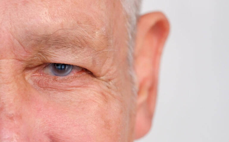 Glaucoma